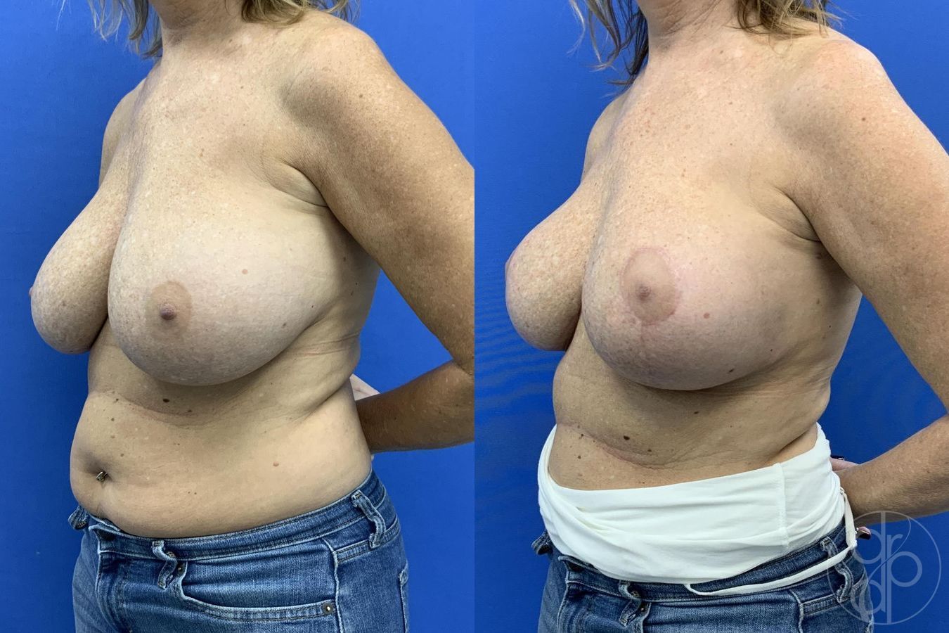 Before and after Breast Implant Revision case 29650 - Angle 3