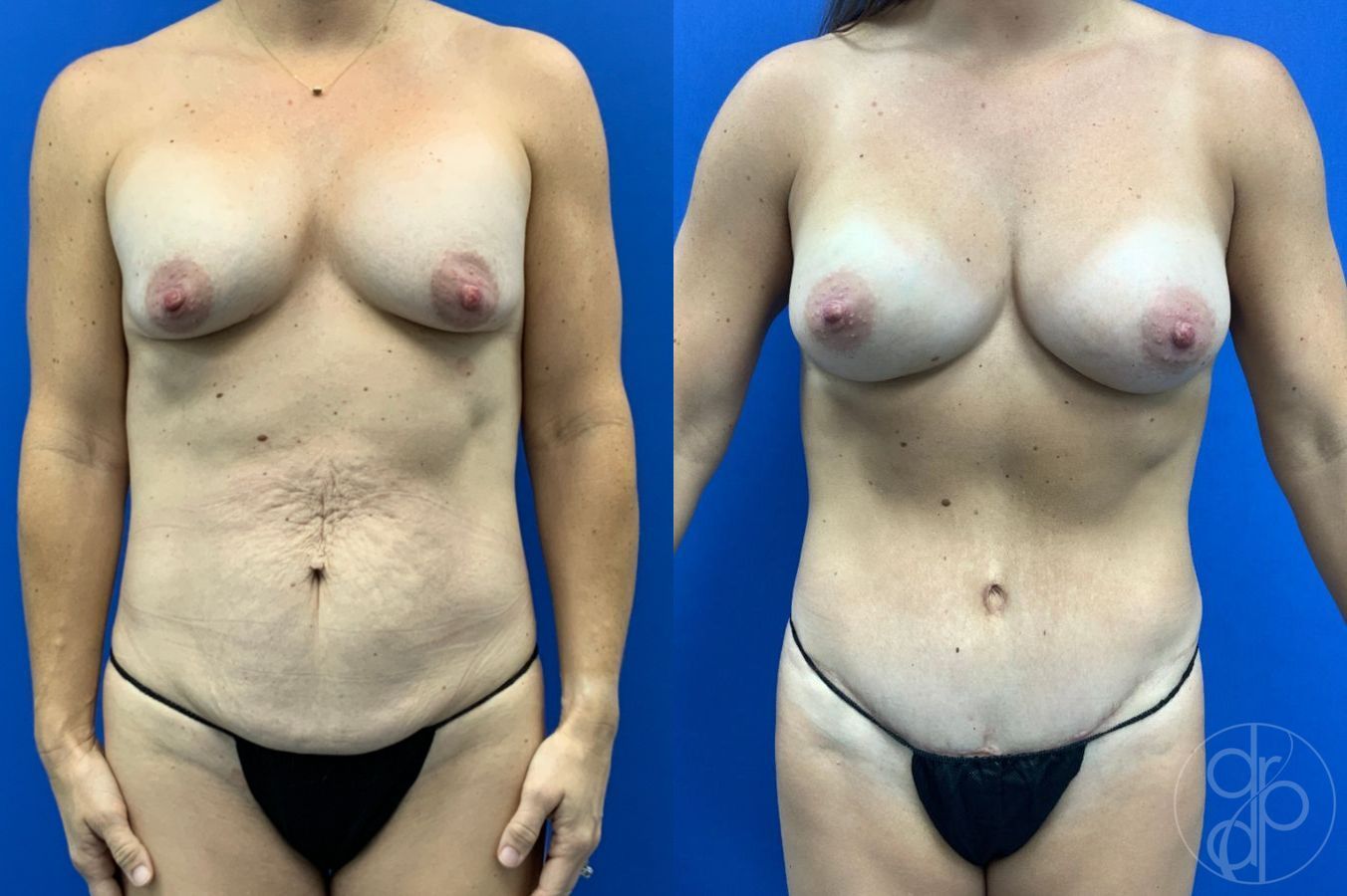 Before and after Abdominoplasty case 46266