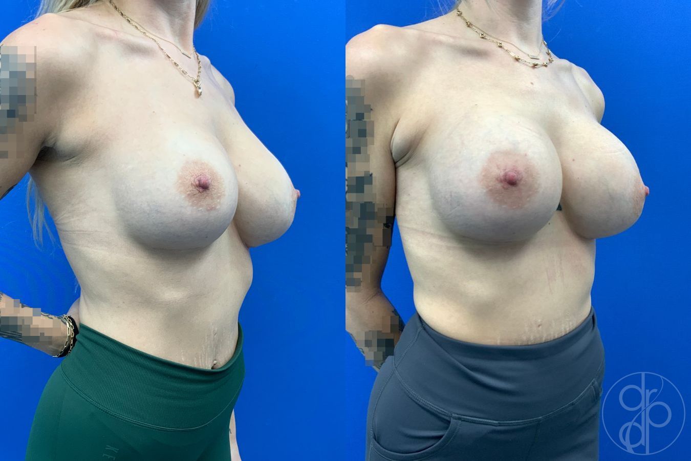 Before and after Breast Implant Revision case 43179 - Angle 4