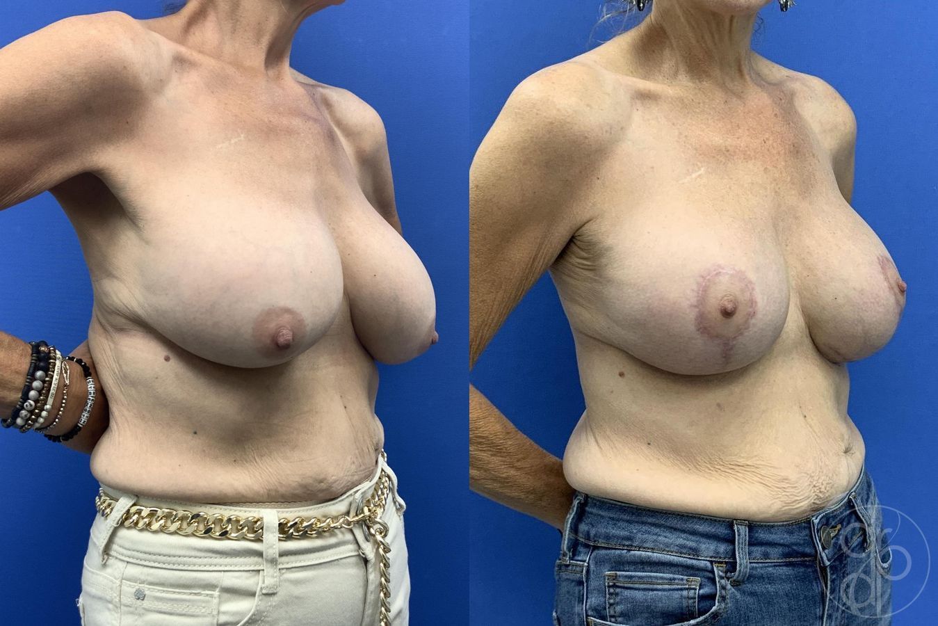 Before and after Breast Implant Revision case 30010 - Angle 3