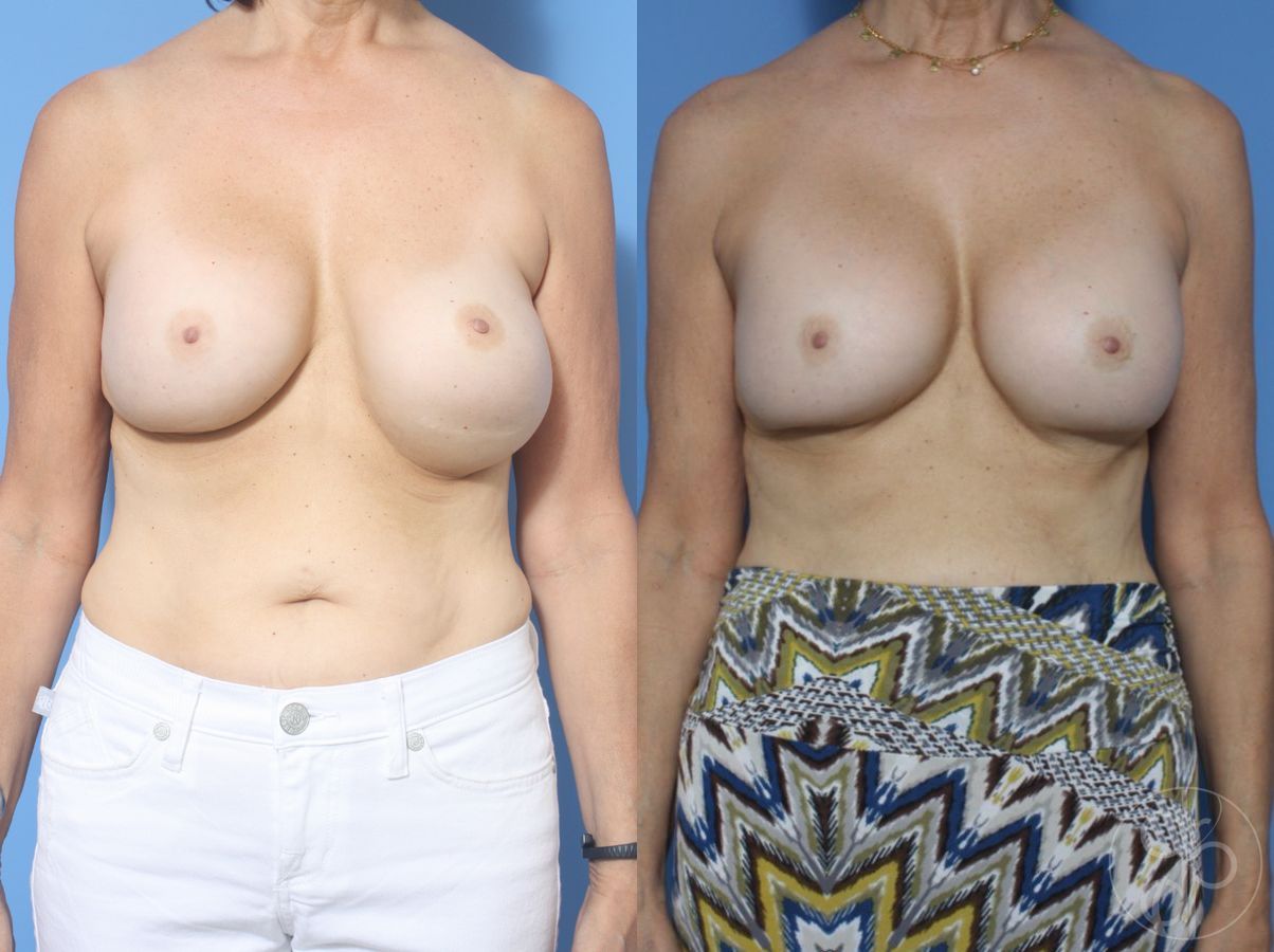Before and after Breast Implant Revision case 29851