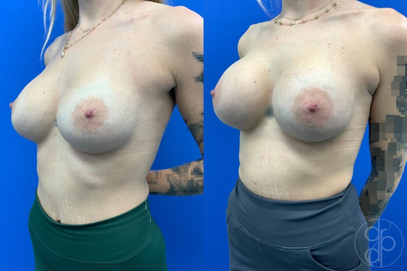 Before and after Breast Implant Revision case 43179 - Angle 3