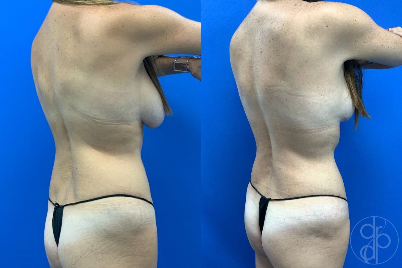 Before and after Liposuction case 43483 - Angle 6