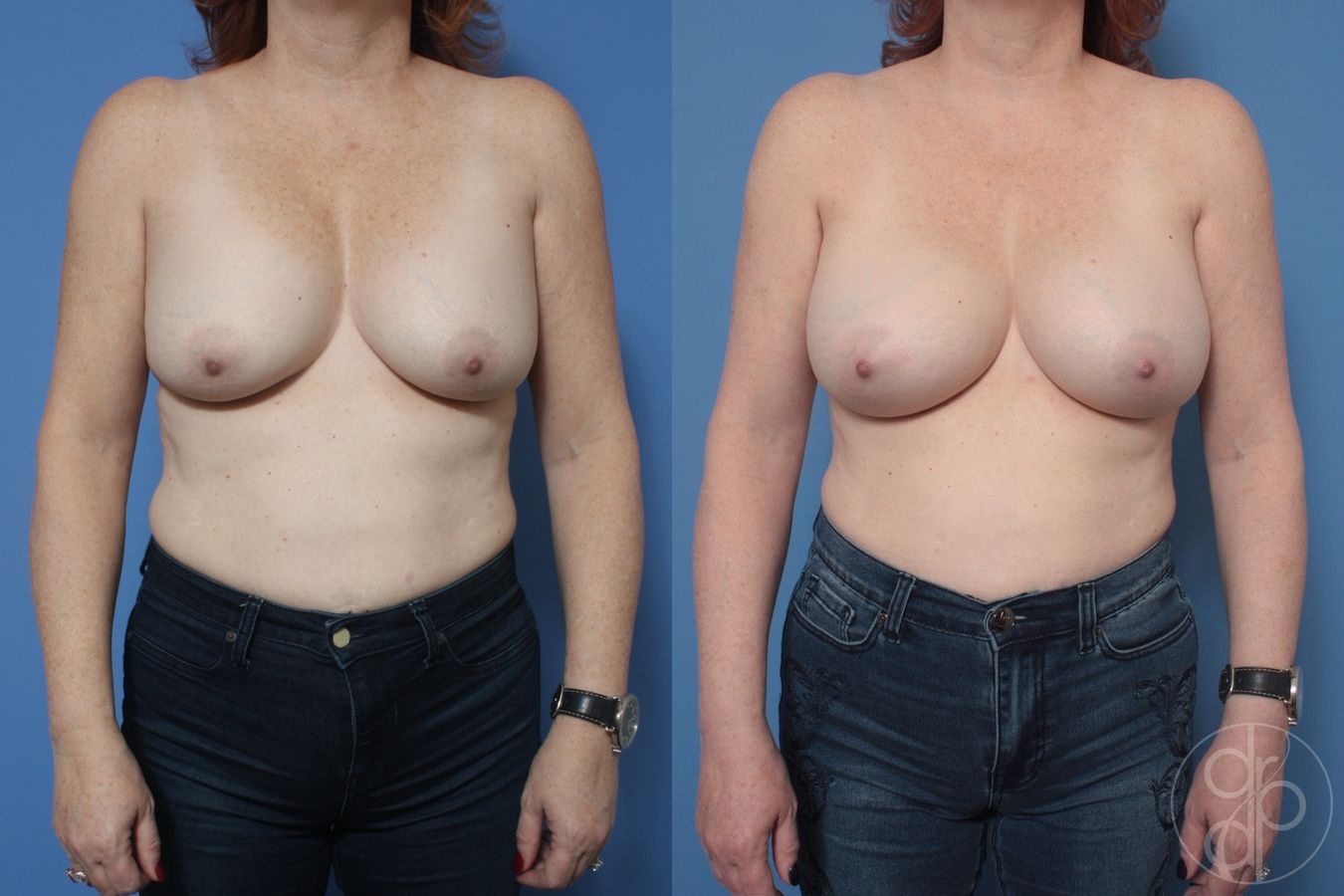 Before and after Breast Implant Revision case 29867