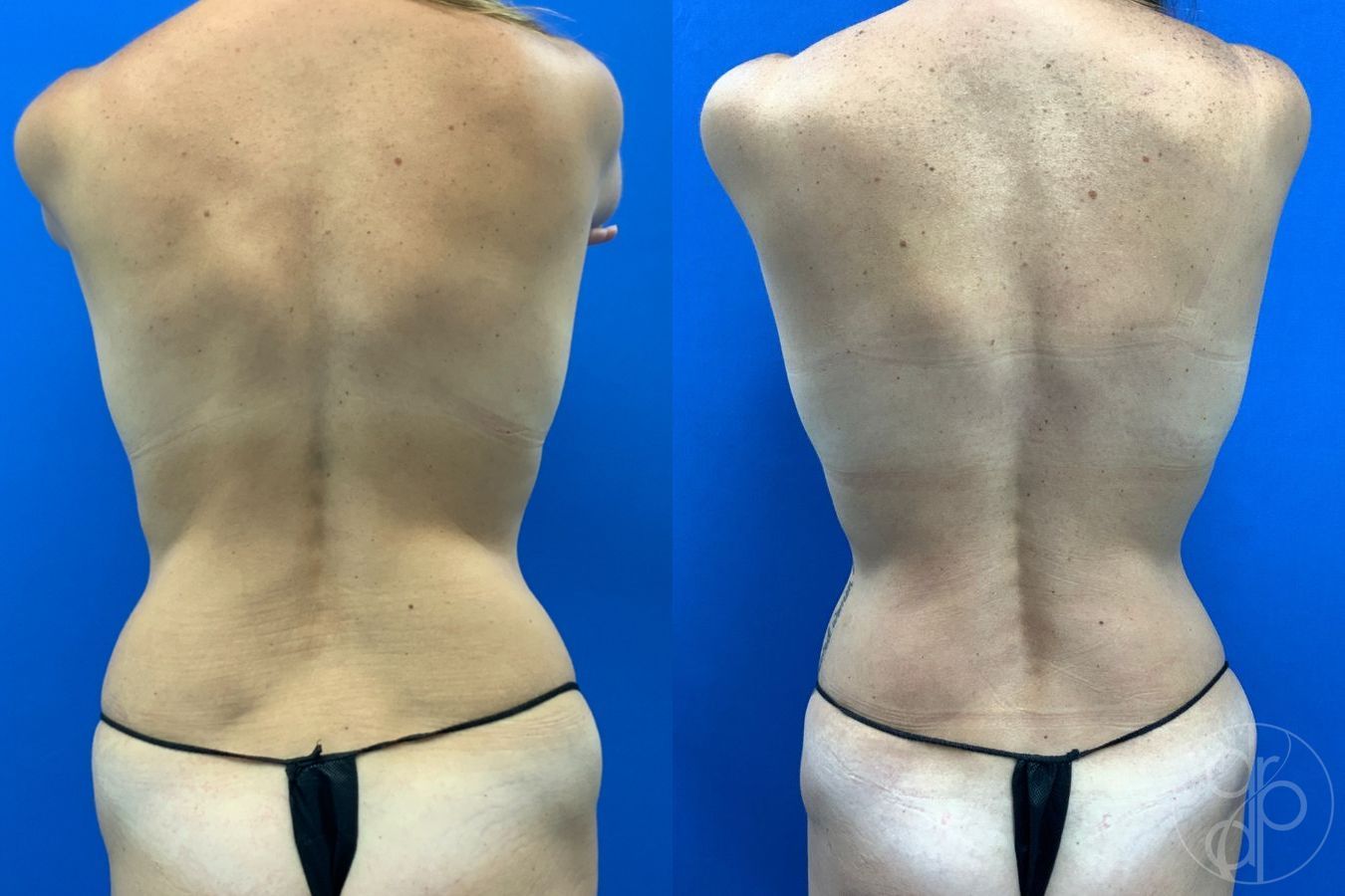 Before and after Liposuction case 43483 - Angle 5