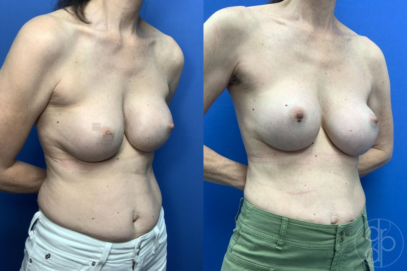 Before and after Breast Implant Revision case 30001 - Angle 3