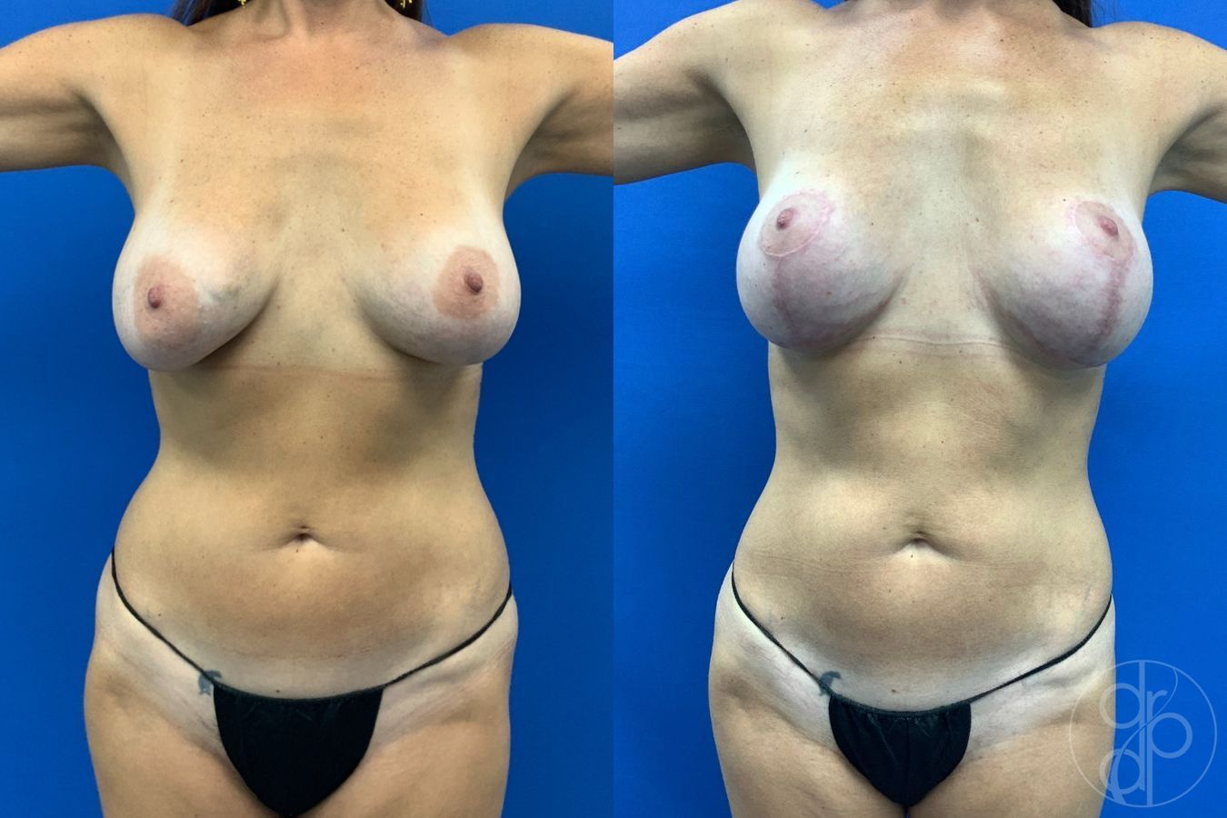 Before and after Liposuction case 43483 - Angle 2