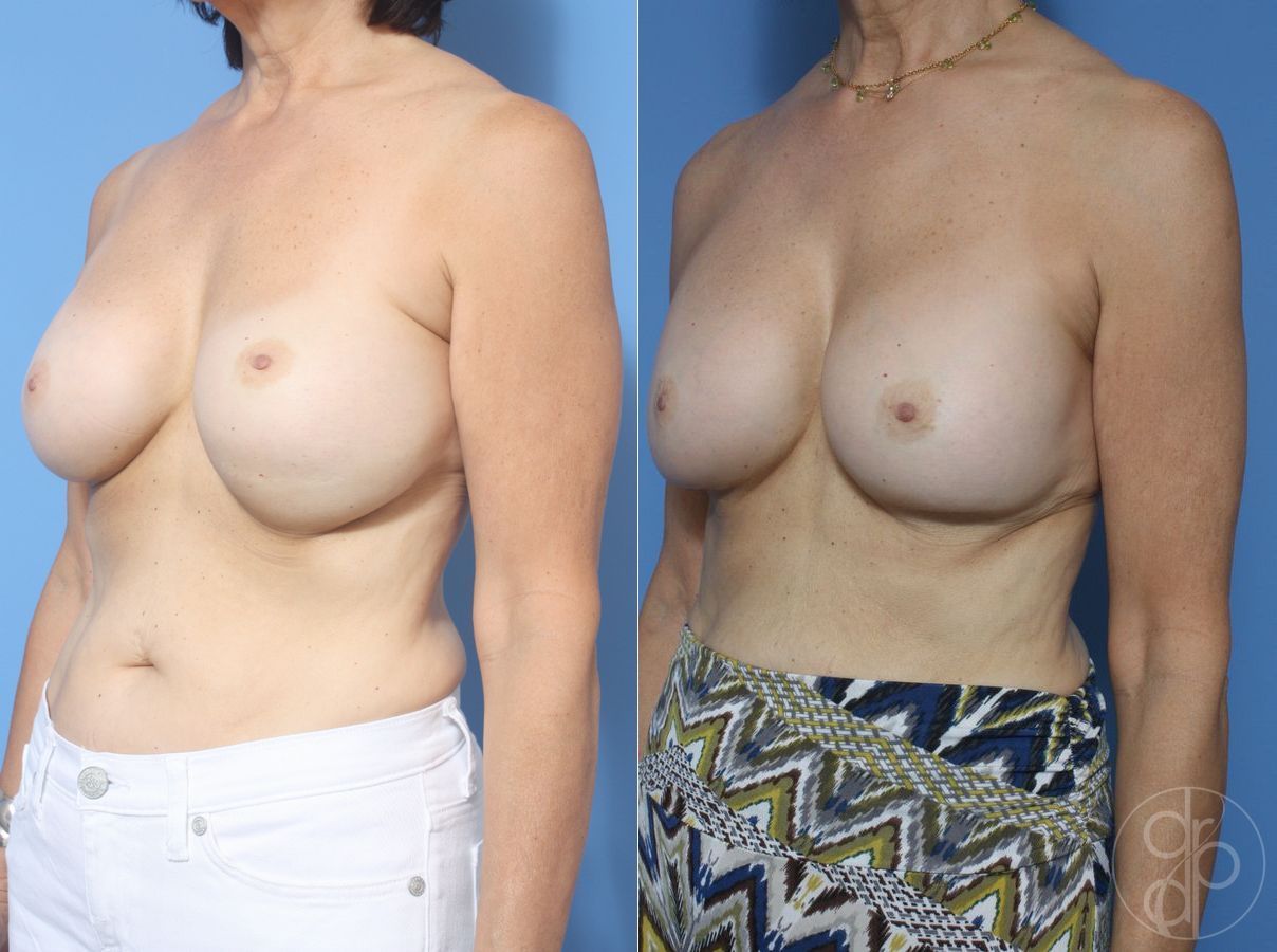 Before and after Breast Implant Revision case 29851 - Angle 3