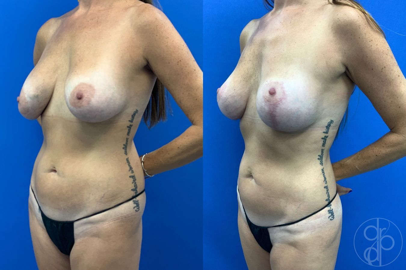 Before and after Liposuction case 43483 - Angle 3