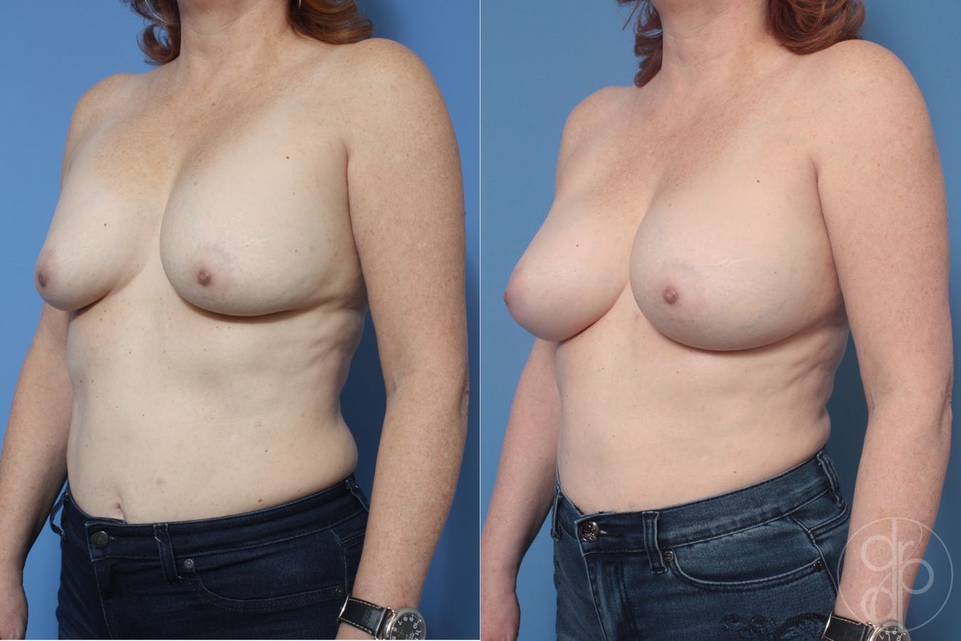 Before and after Breast Implant Revision case 29867 - Angle 2