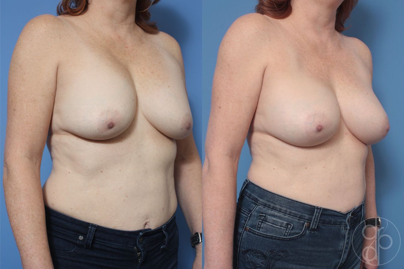Before and after Breast Implant Revision case 29867 - Angle 3
