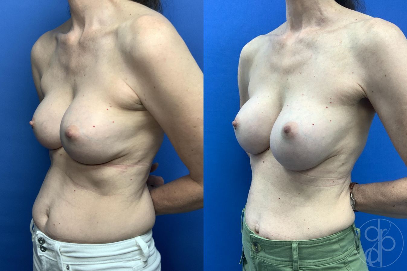Before and after Breast Implant Revision case 30001 - Angle 2