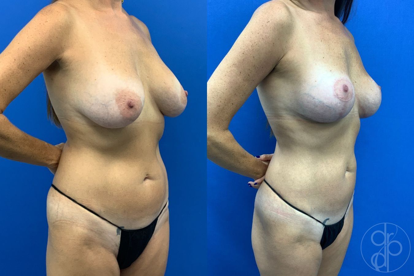 Before and after Liposuction case 43483 - Angle 7