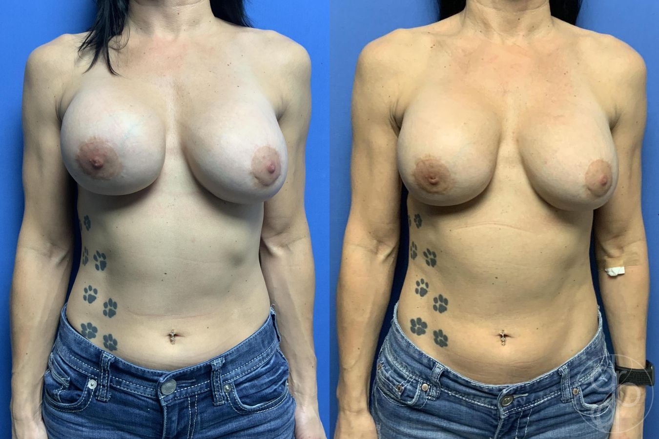 Before and after Breast Implant Revision case 29593
