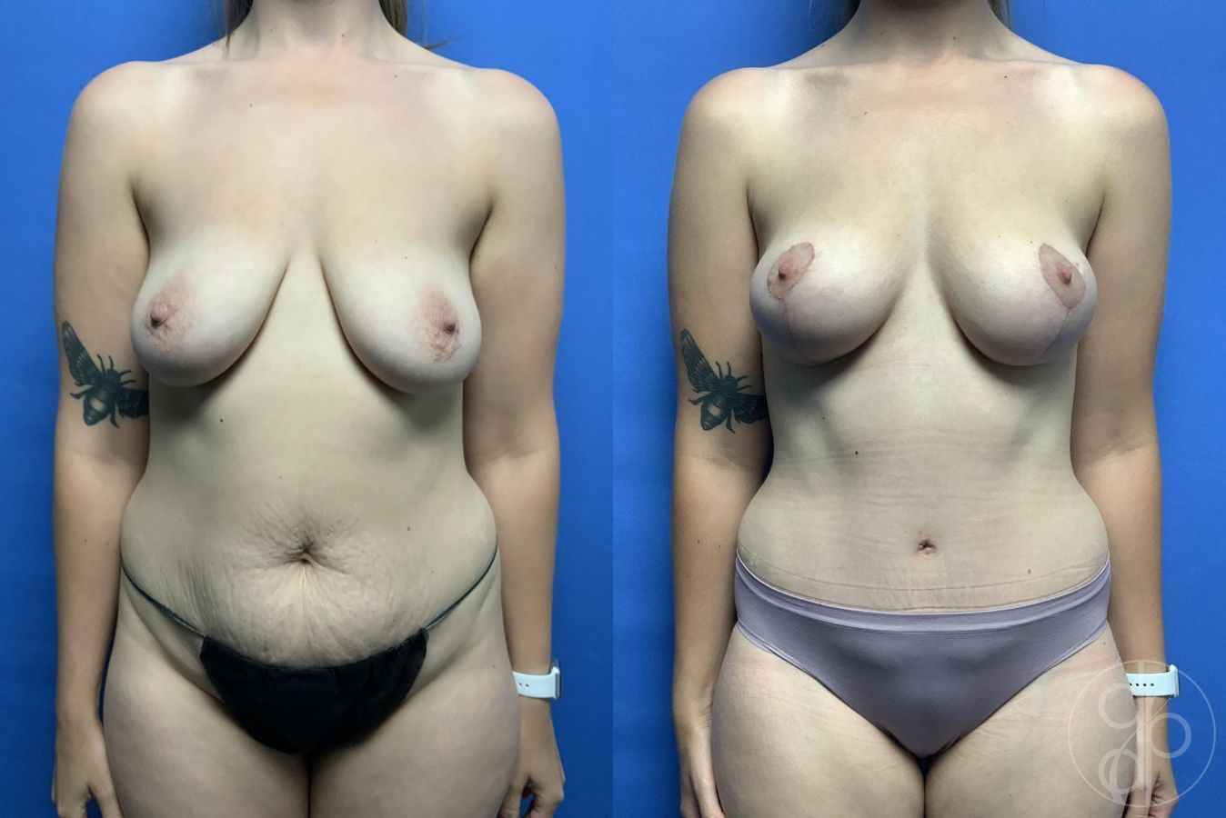 Before and after Breast Lift case 29703