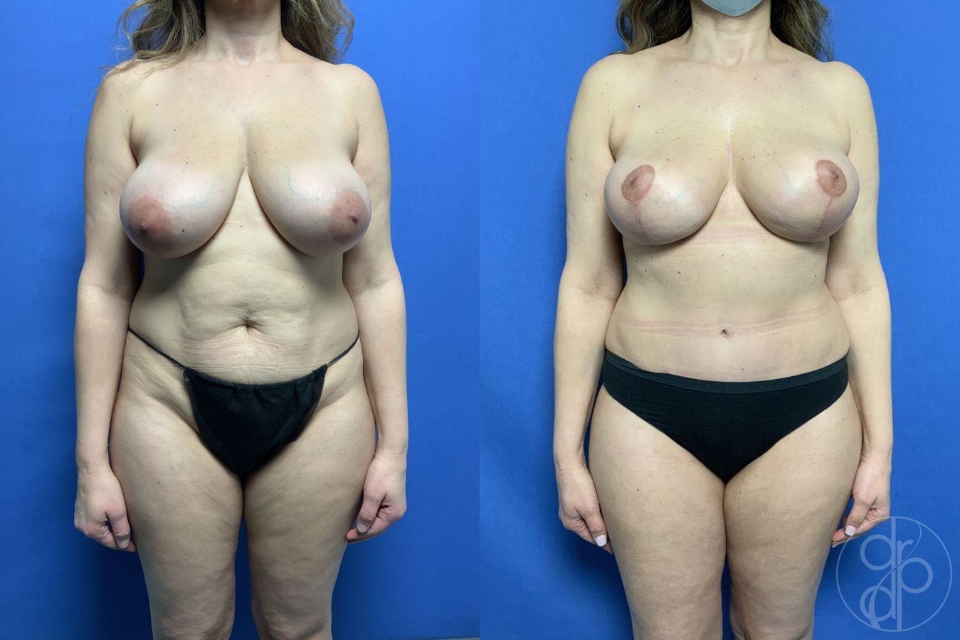 Before and after Breast Lift case 29738