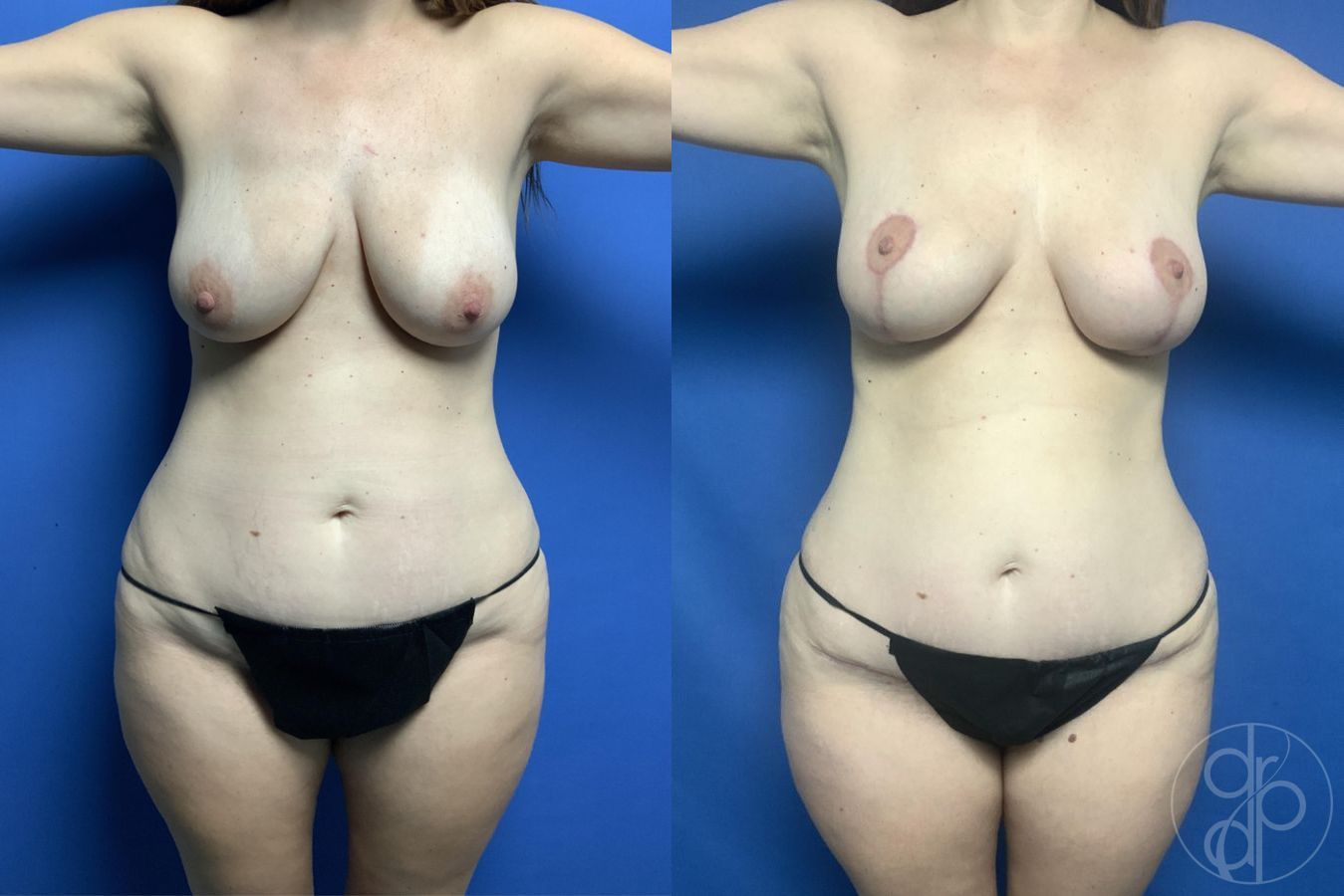 Before and after Mommy Makeover case 29724