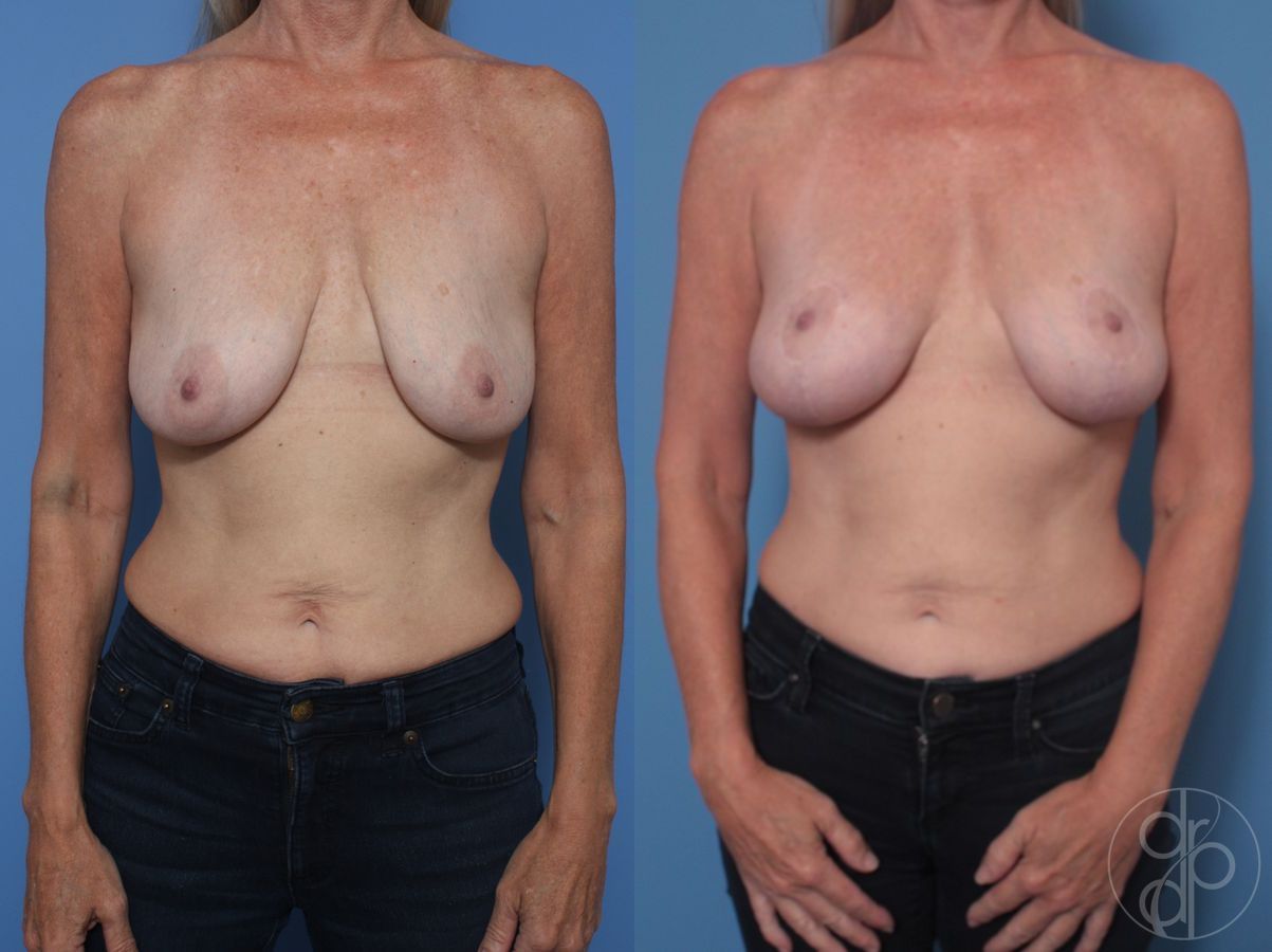 Before and after Breast Lift case 29827
