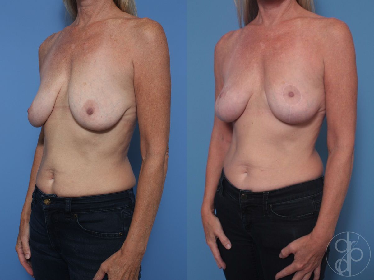 Before and after Breast Lift case 29827 - Angle 2