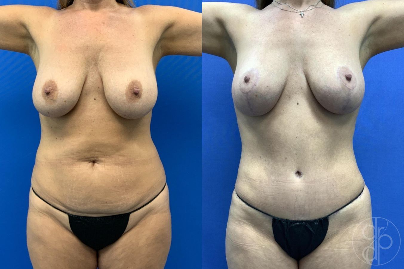 Before and after Mommy Makeover case 29653 - Angle 2