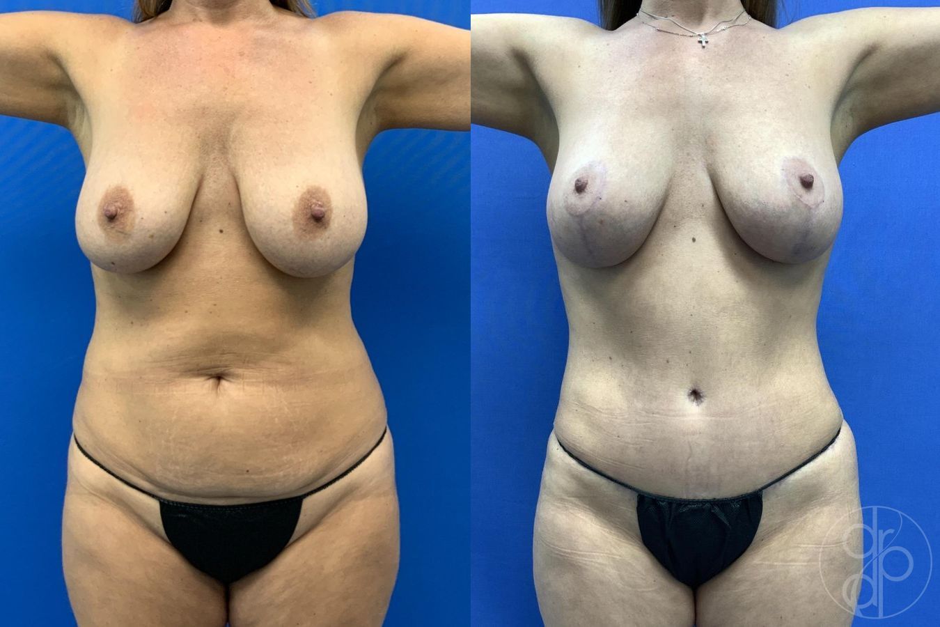 Before and after Liposuction case 29653 - Angle 2