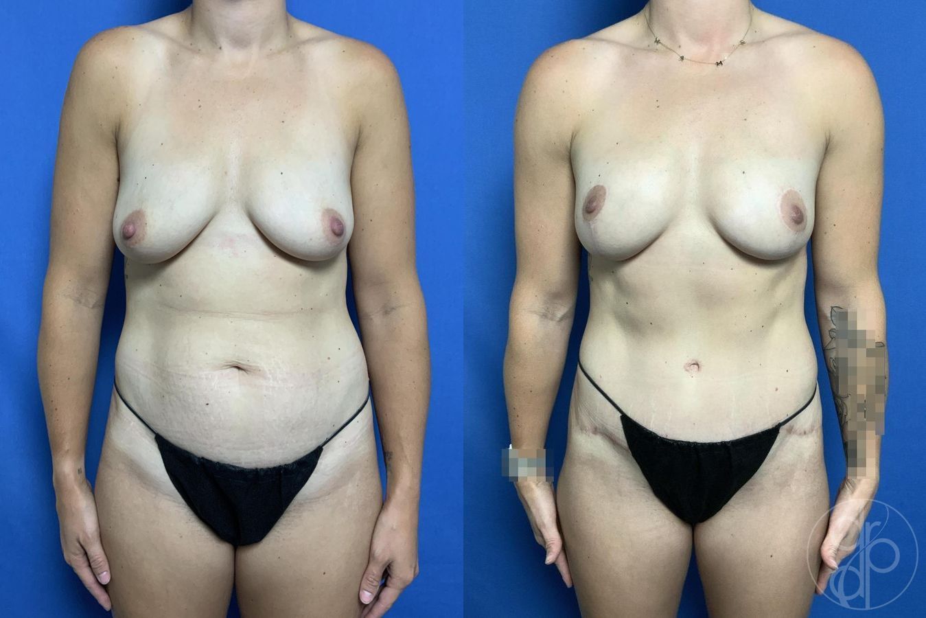 Breast Lift - Case 490