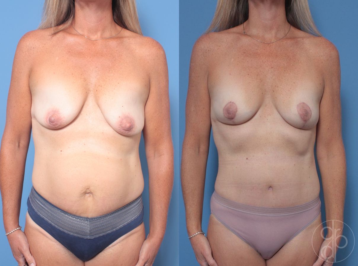 Before and after Mommy Makeover case 29701