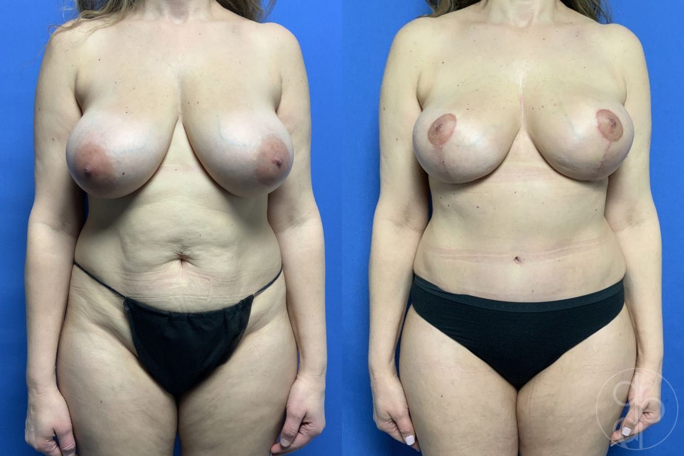 Before and after Mommy Makeover case 29738