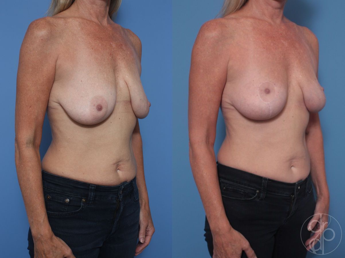 Before and after Breast Lift case 29827 - Angle 3