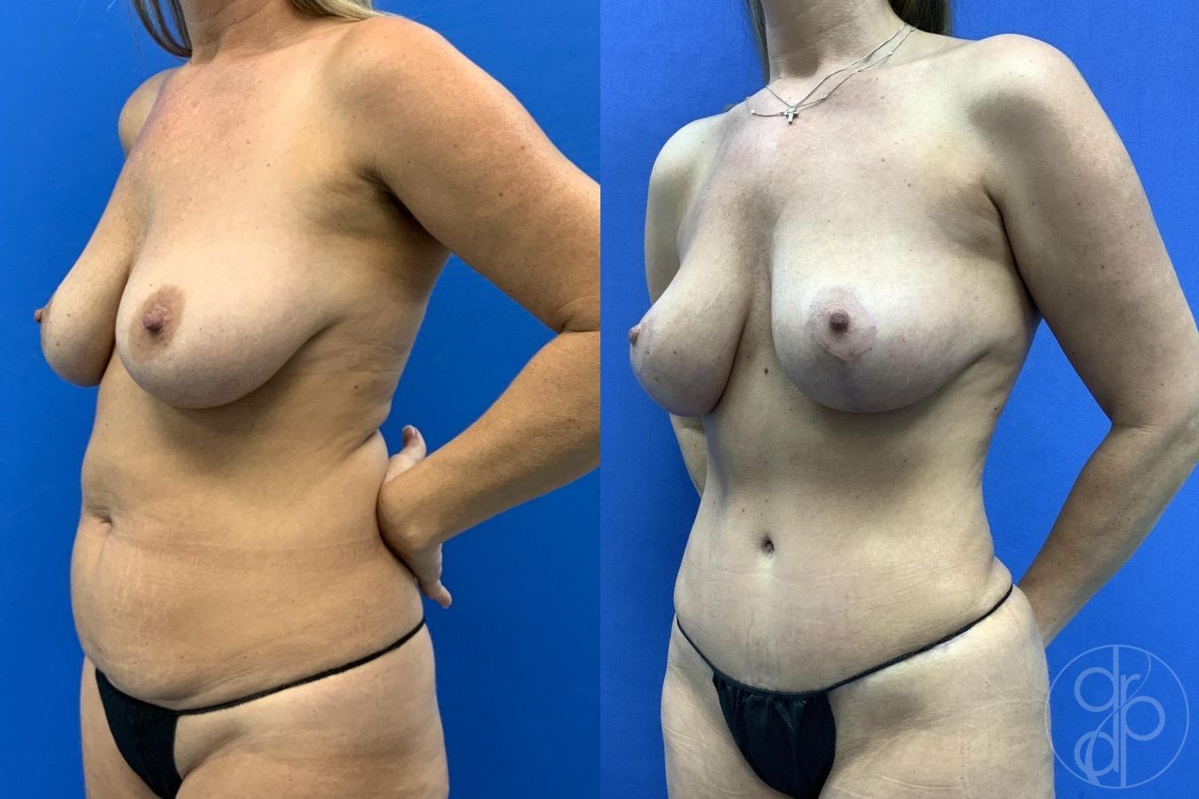 Before and after Liposuction case 29653 - Angle 3