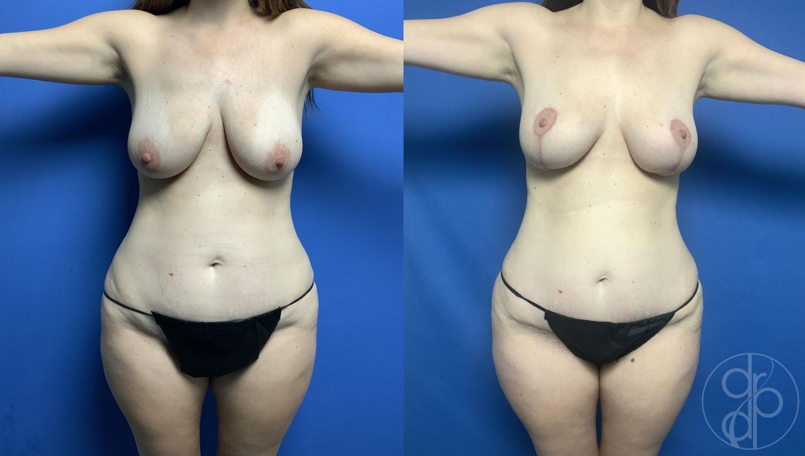Before and after Breast Lift case 29724