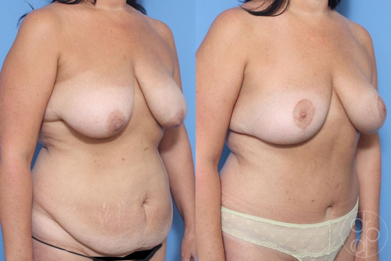 Before and after Abdominoplasty case 30009 - Angle 3