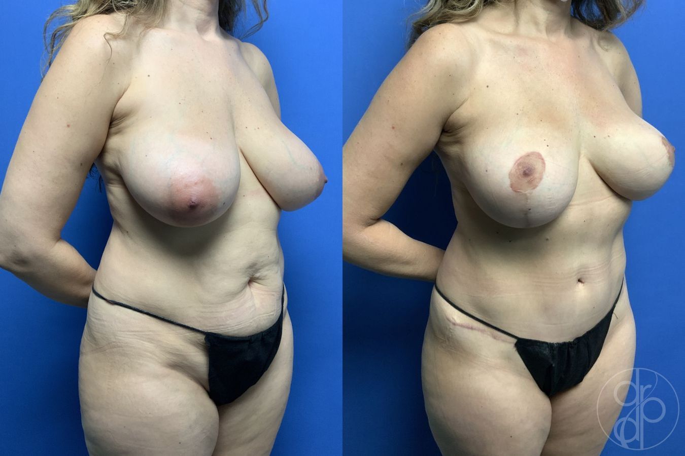 Before and after Mommy Makeover case 29738 - Angle 2