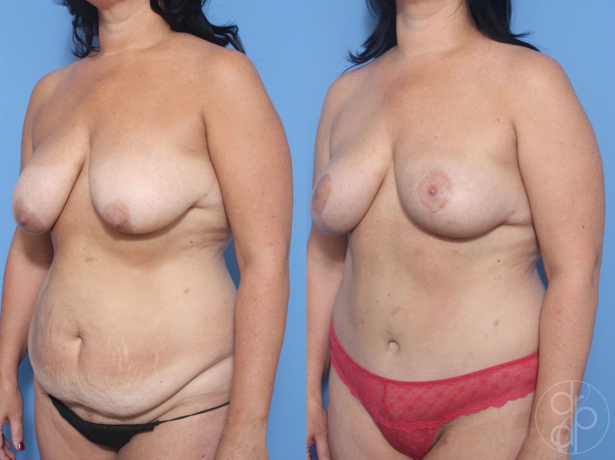 Before and after Breast Lift case 30009 - Angle 3