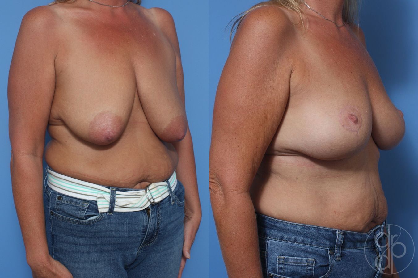 Before and after Breast Lift case 29832 - Angle 2