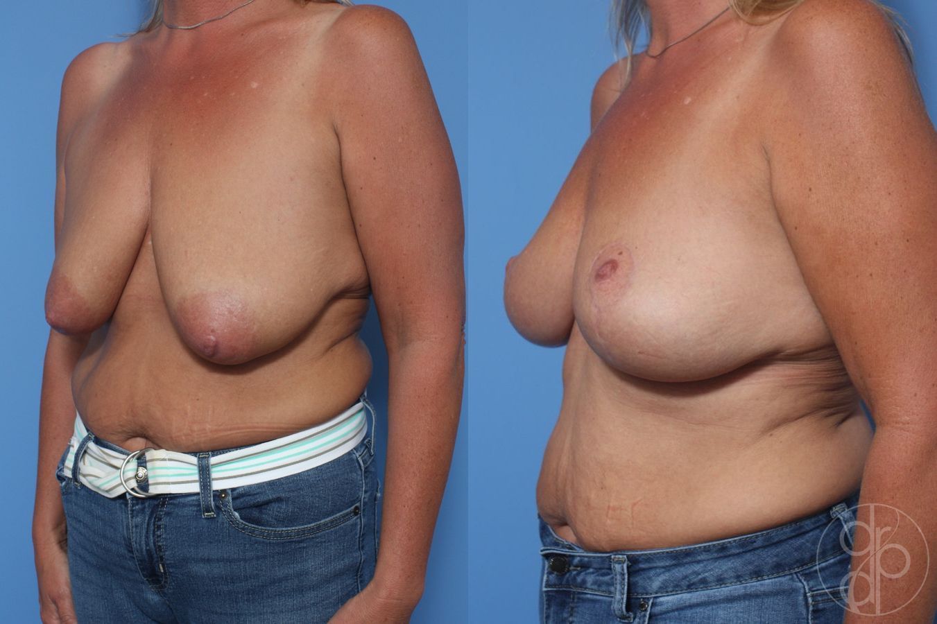 Before and after Breast Lift case 29832 - Angle 3