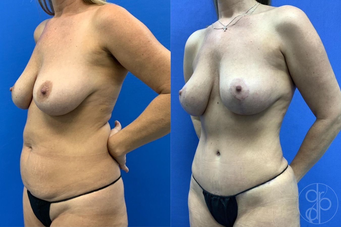 Before and after Mommy Makeover case 29653 - Angle 3