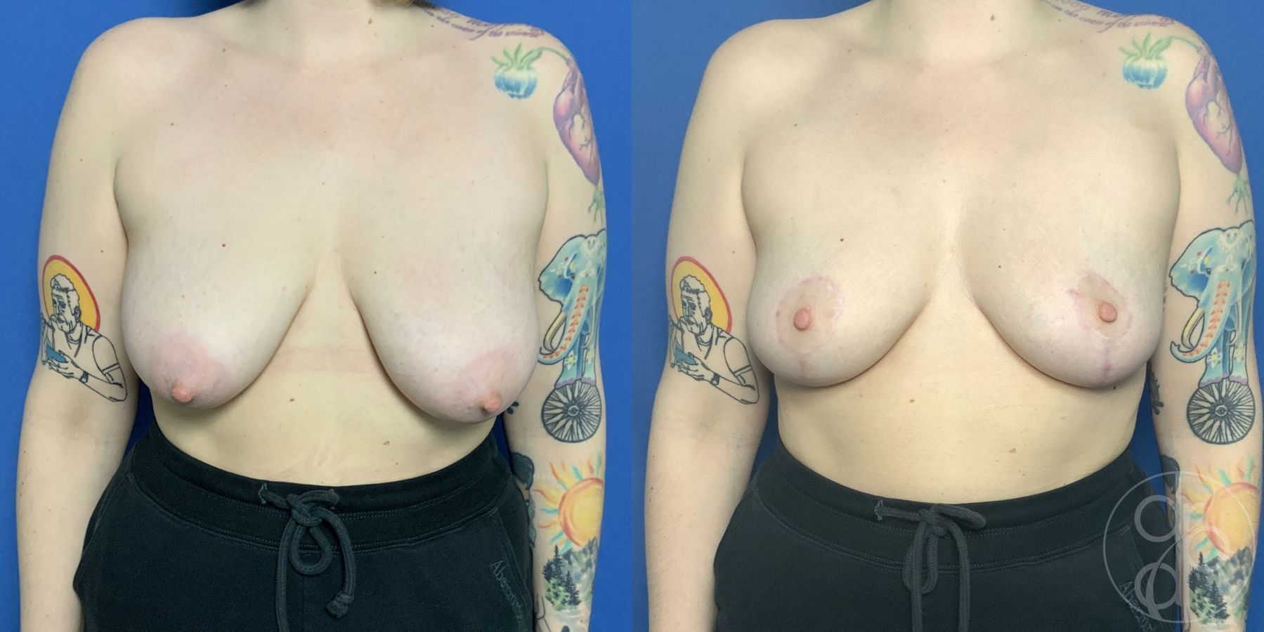 Before and after Breast Lift case 29899