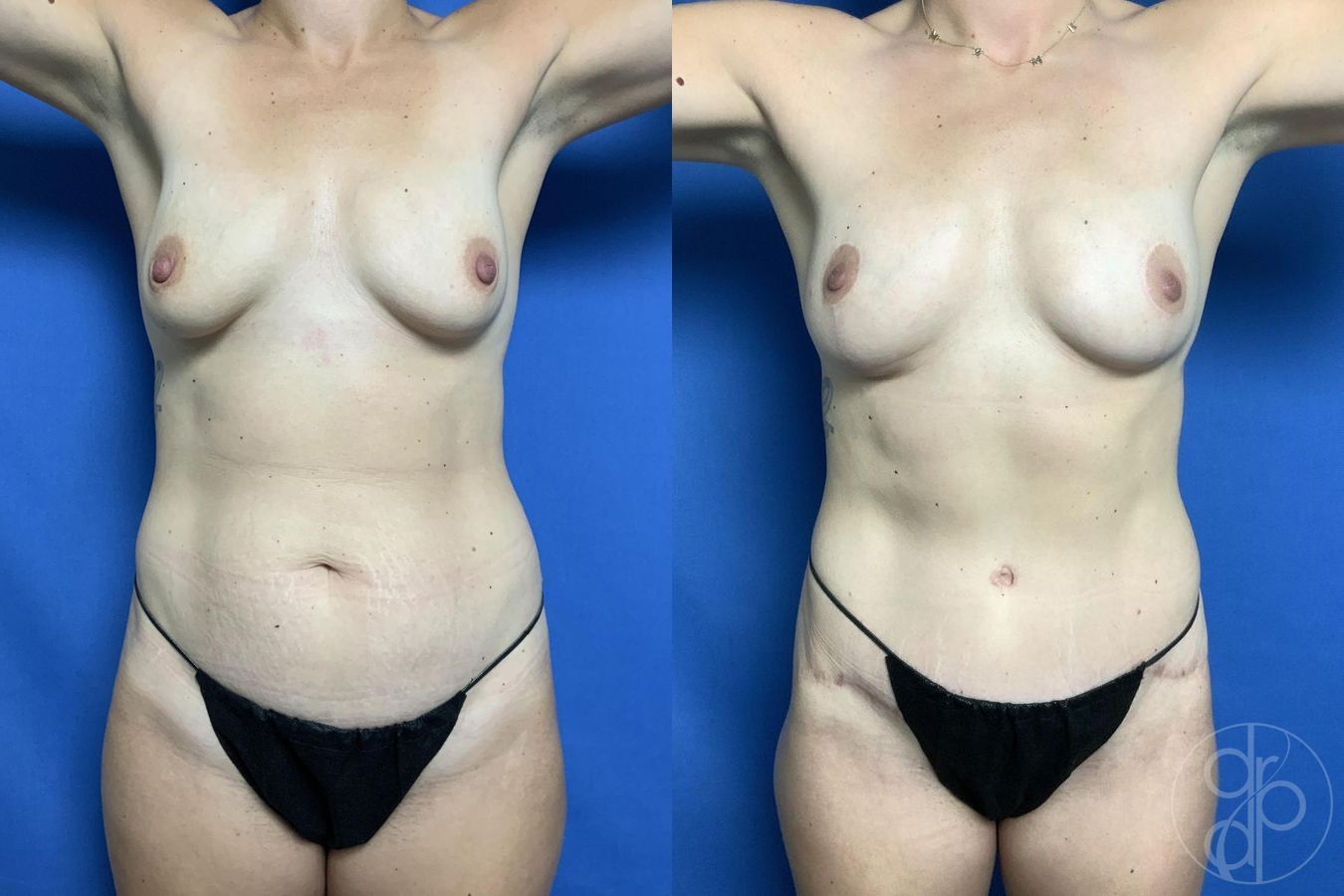 Before and after Breast Lift case 29726 - Angle 2