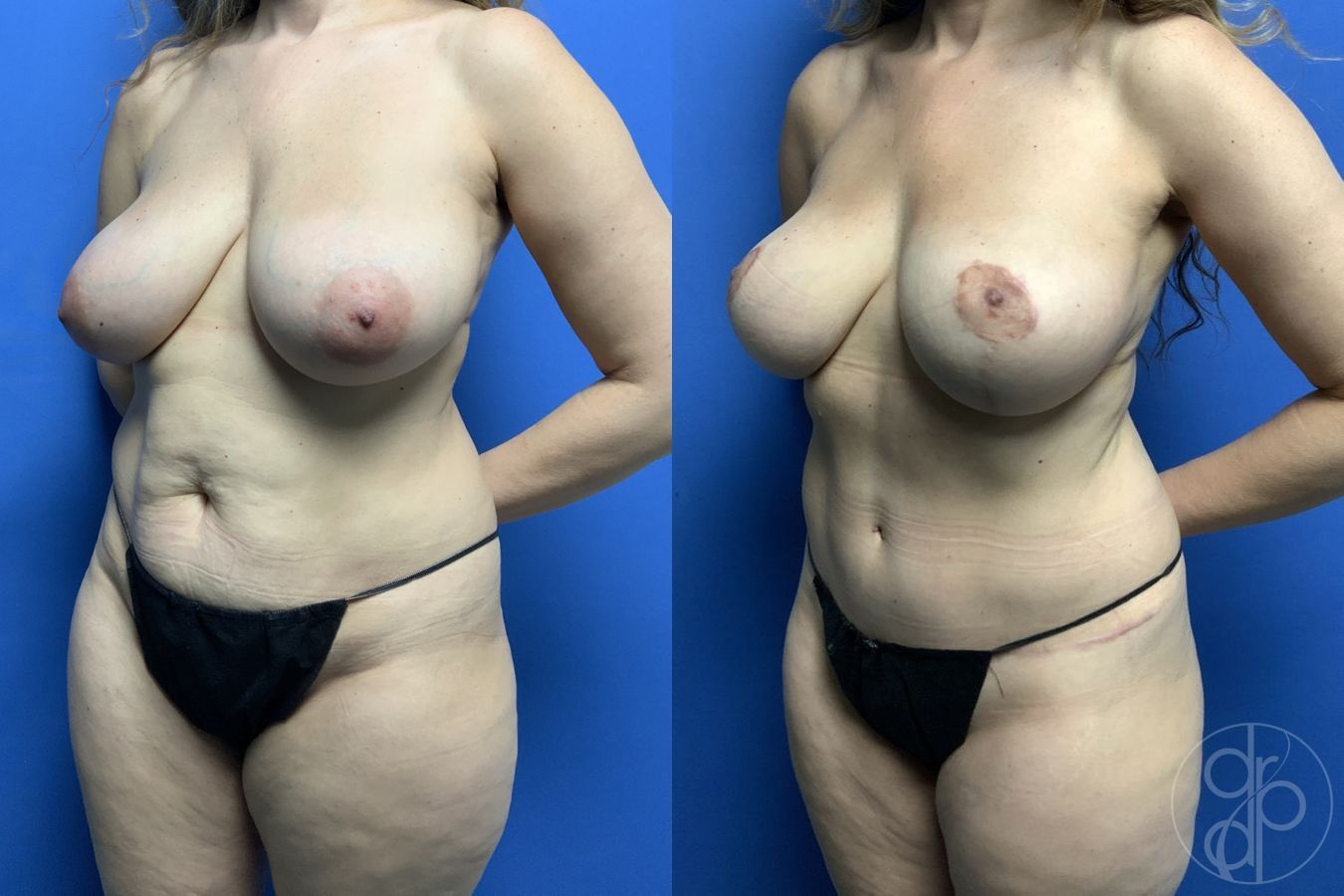 Before and after Mommy Makeover case 29738 - Angle 3