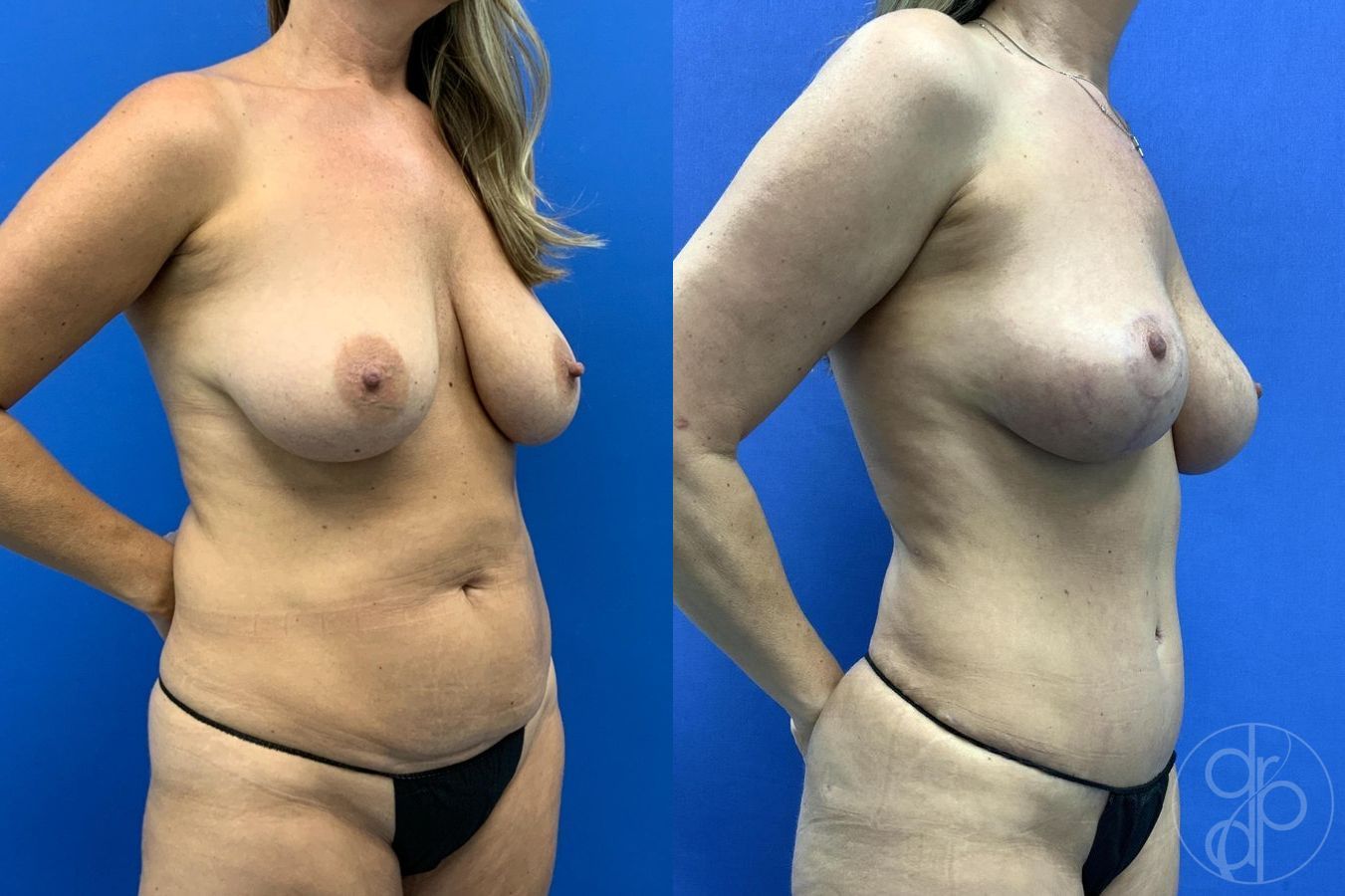 Before and after Liposuction case 29653 - Angle 4