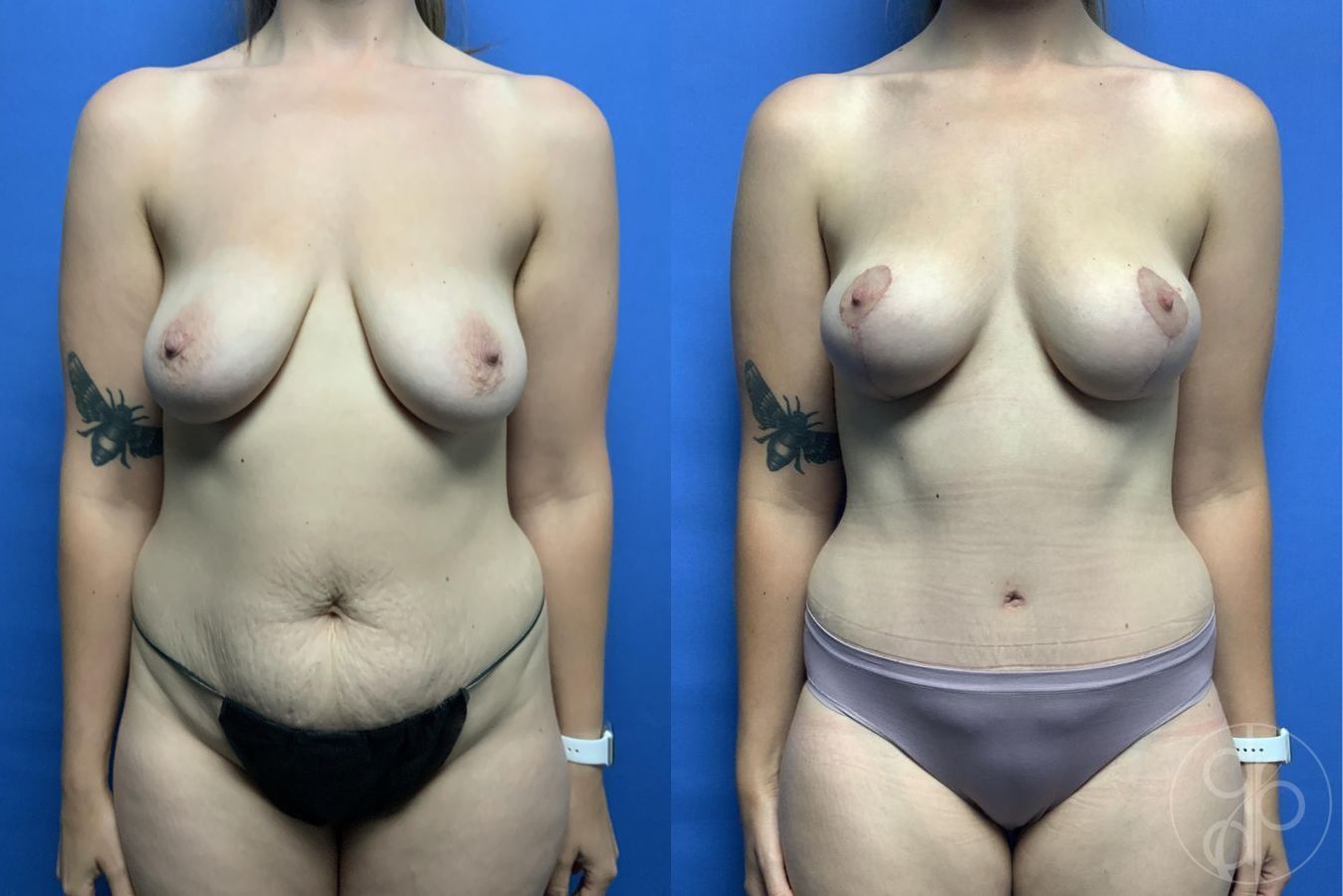 Before and after Mommy Makeover case 29703