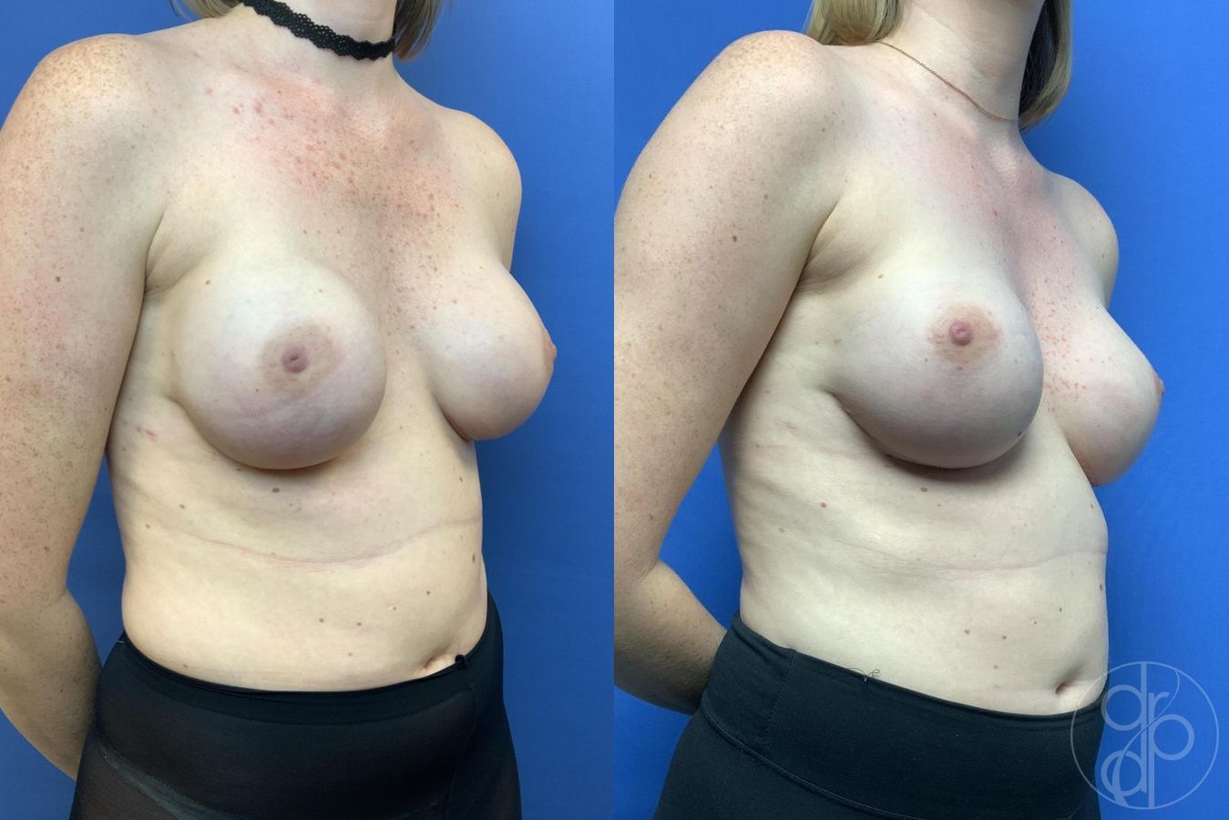 Breast Reconstruction - Thumbnail 4