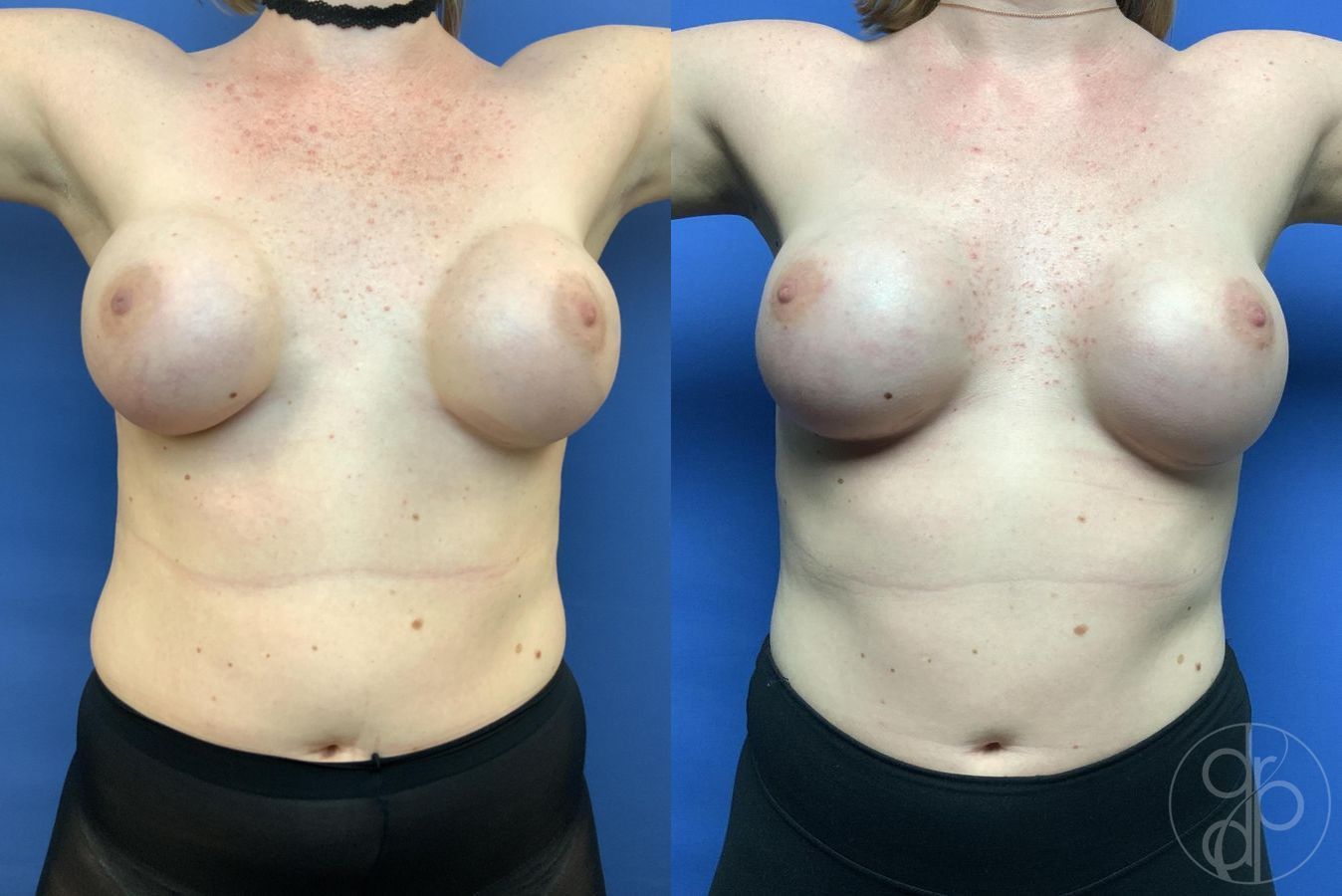 Breast Reconstruction - Thumbnail 2