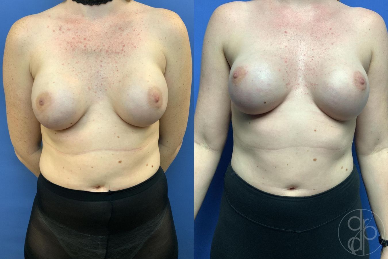 Breast Reconstruction - Case 609