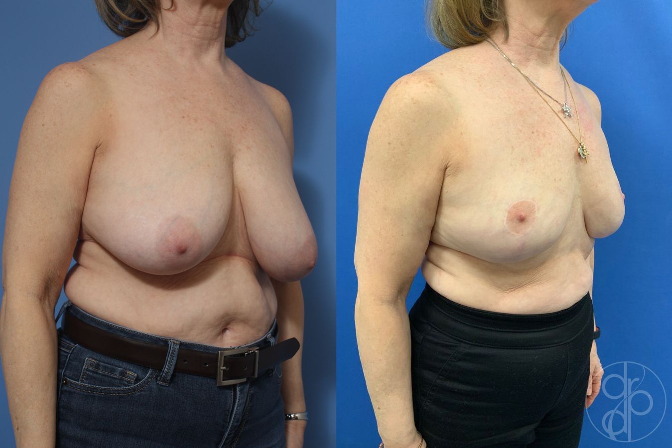 Before and after Breast Reduction case 29845 - Angle 2