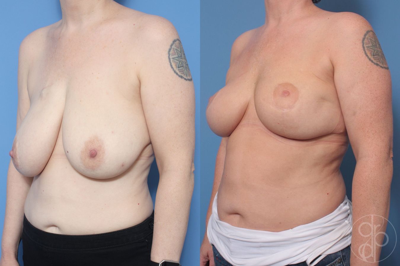 Before and after Breast Reduction case 29871 - Angle 2