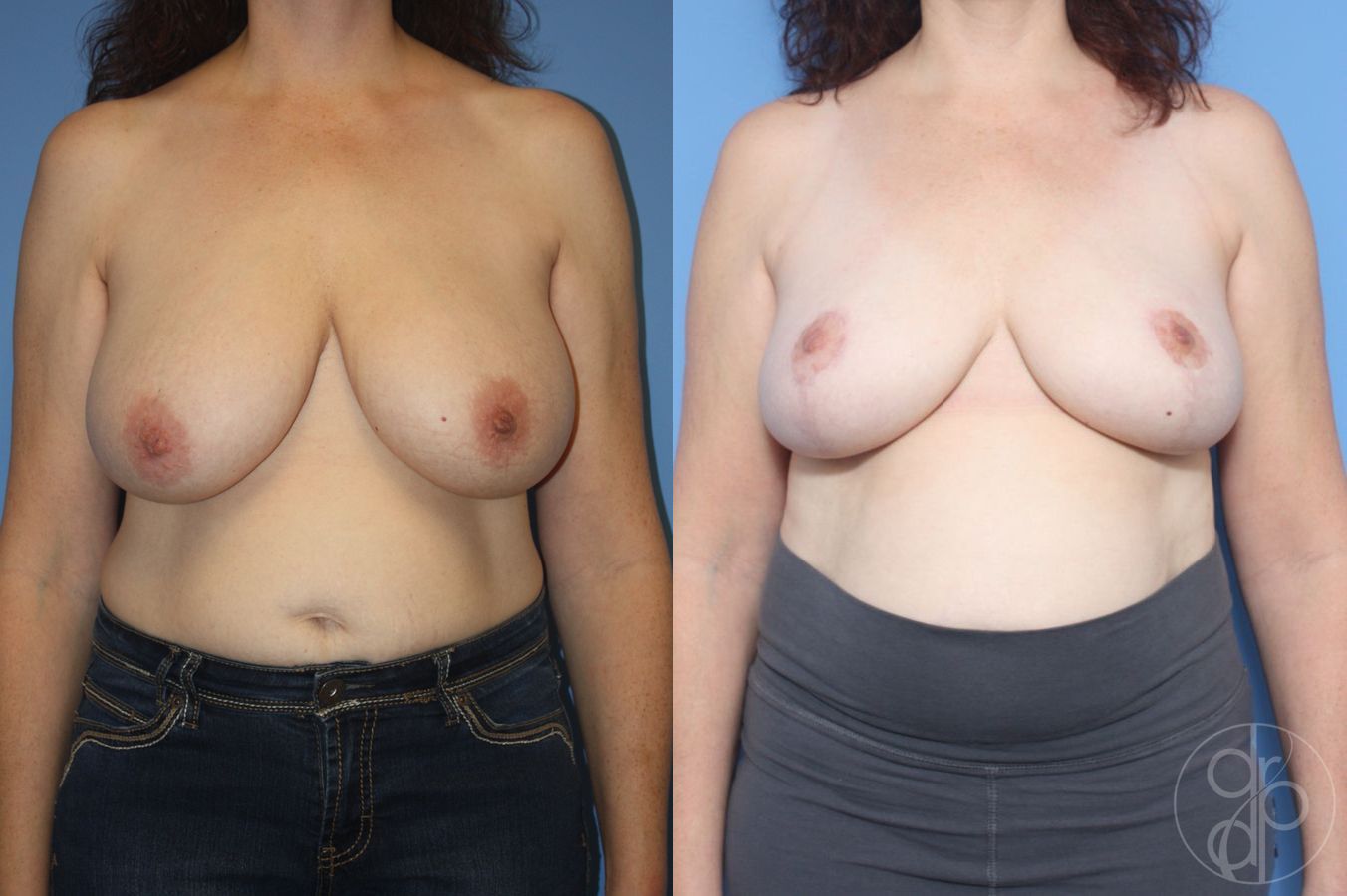 Before and after Breast Reduction case 29860
