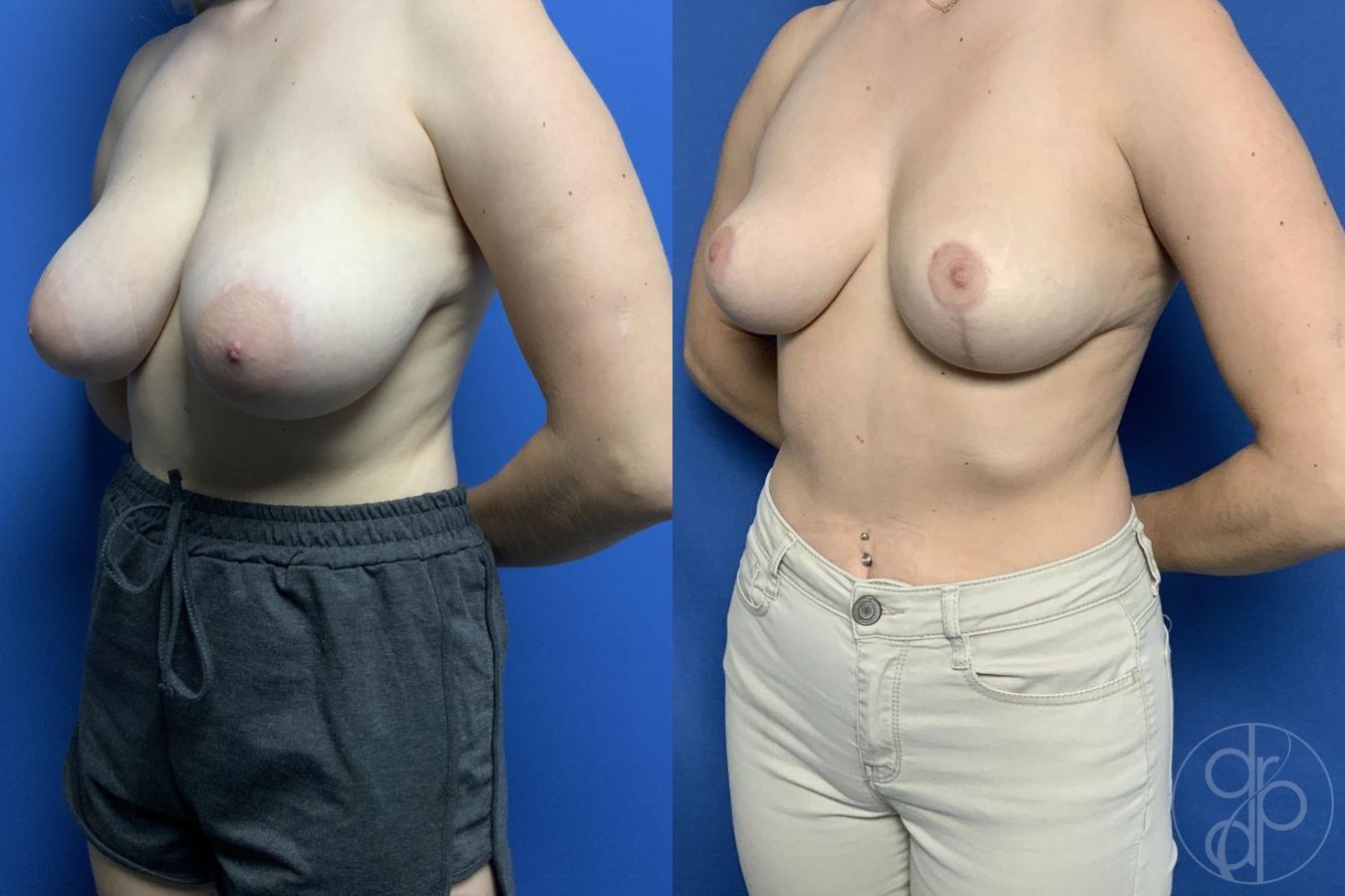Before and after Breast Reduction case 29784 - Angle 2