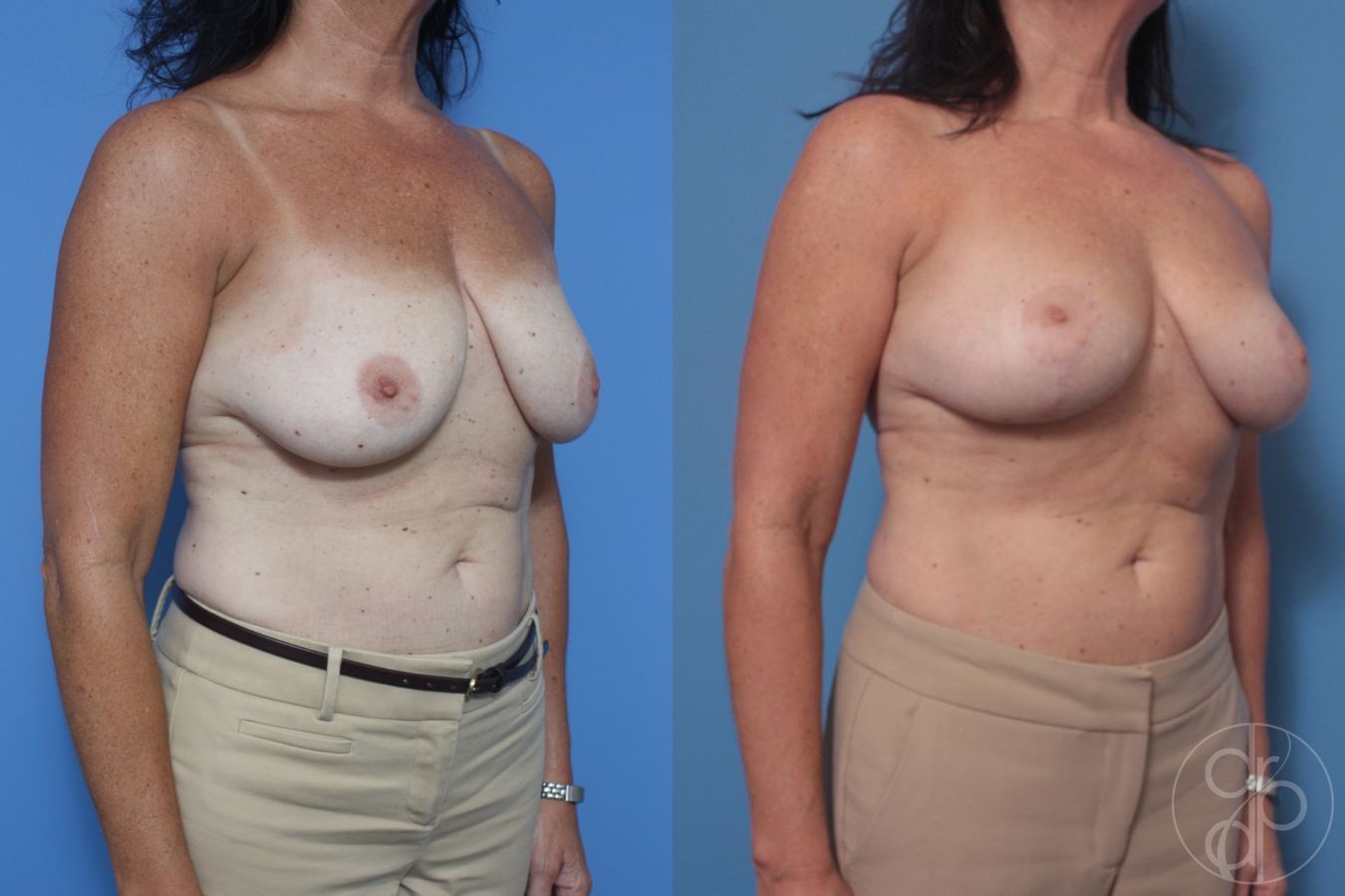 Before and after Breast Reduction case 29849 - Angle 3